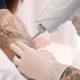 How to remove a permanent tattoo