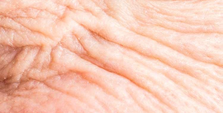 what is wrinkly skin syndrome