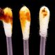 What Does It Mean If Your Earwax Is Black