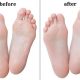 The Foot Callus Remover