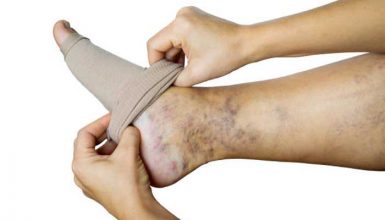 How to Choose and Use Compression Stockings