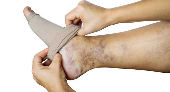 How to Choose and Use Compression Stockings